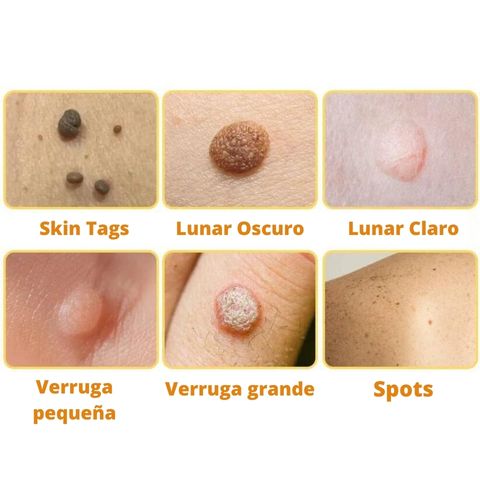 DERMABEE - TRATAMIENTO CON VENENO DE ABEJA PARA VERRUGAS Y MANCHAS