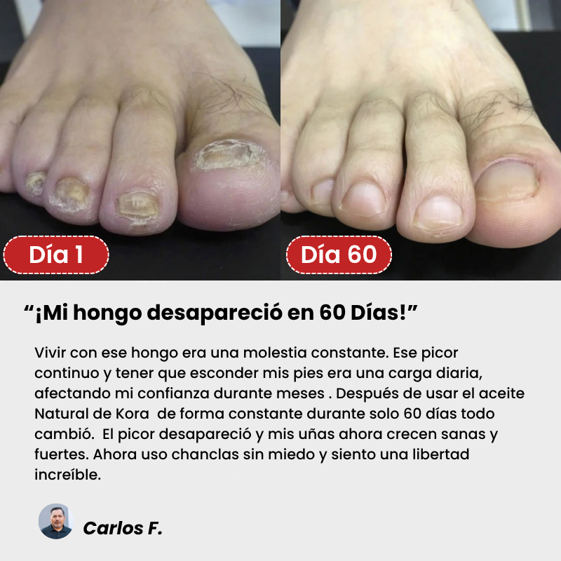 Kora™ - Tratamiento Antihongos Triple Acción / terbinafina 8%