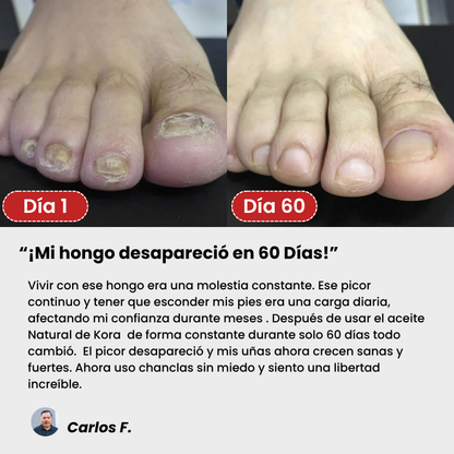 Kora™ - Tratamiento Antihongos Triple Acción / terbinafina 8%