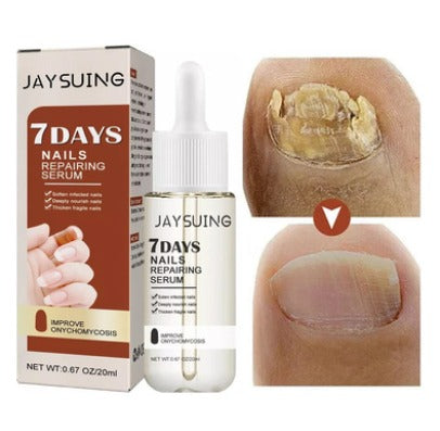 PODEROSO ANTIFUNGICO - ELIMINA HONGOS UÑAS Y PIES EN 7 DIAS®